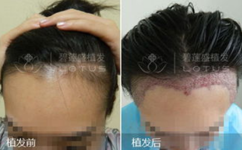 太原碧蓮盛植發(fā)好不好?醫(yī)院地址在哪?附植發(fā)醫(yī)生介紹