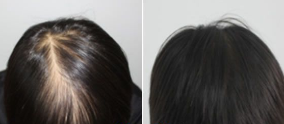 沈陽大麥微針植發(fā)靠譜嗎?內(nèi)附頭發(fā)種植案例及植發(fā)價(jià)格表分享