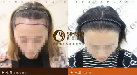 上海華美植發(fā)醫(yī)院怎么樣?醫(yī)院地址在哪里?附植發(fā)經(jīng)歷分享~