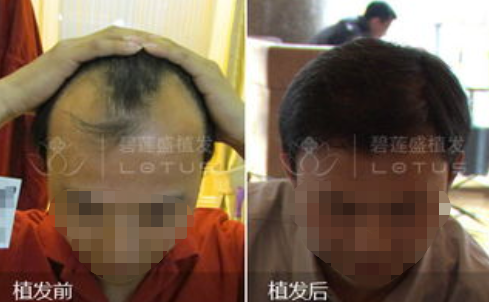 石家莊碧蓮盛植發(fā)機構(gòu)介紹，內(nèi)附醫(yī)院地址+植發(fā)案例及價格表分享