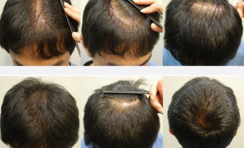 沈陽博士園植發(fā)怎么樣?附植發(fā)專家+價格表分享
