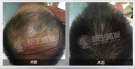 深圳新生植發(fā)如何?梁明成醫(yī)生植發(fā)怎么樣?附醫(yī)院價(jià)格表