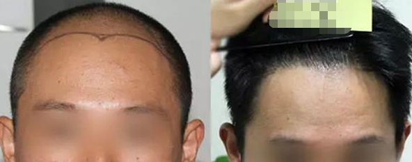 青島雍禾植發(fā)機(jī)構(gòu)怎么樣?植發(fā)正規(guī)嗎?附醫(yī)院醫(yī)生介紹+價格表