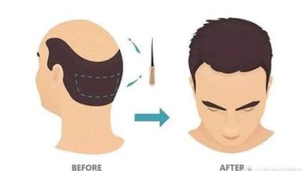 南寧碧蓮盛植發(fā)好不好?術(shù)前術(shù)后需要注意什么?附植發(fā)價格表