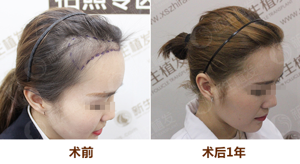 做完植發(fā)手術(shù)后頭發(fā)會(huì)脫落嗎?植發(fā)后效果怎么樣?