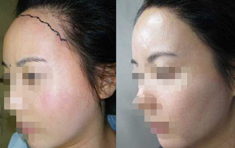 東莞新生植發(fā)醫(yī)院地址在哪?附個(gè)人發(fā)際線種植經(jīng)歷分享