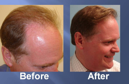 植發(fā)手術的價格貴嗎?植發(fā)手術費用大概多少錢?