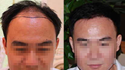 成都大麥微針植發(fā)醫(yī)院怎么樣?點(diǎn)擊查看植發(fā)醫(yī)生信息+植發(fā)案例分享