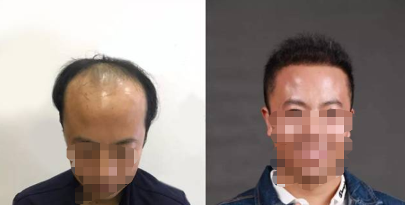 鄭州新華中醫(yī)院植發(fā)科靠譜嗎?醫(yī)院李云醫(yī)生怎么樣?附醫(yī)院簡介