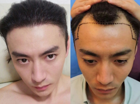 植發(fā)手術(shù)的過程中疼不疼?手術(shù)一般多長時(shí)間就做完了?