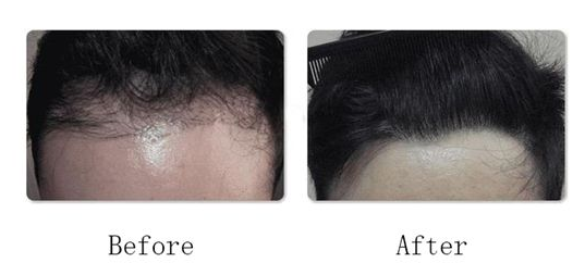 合肥維多利亞植發(fā)醫(yī)院怎么樣?附地址_醫(yī)生介紹_植發(fā)案例_價格表