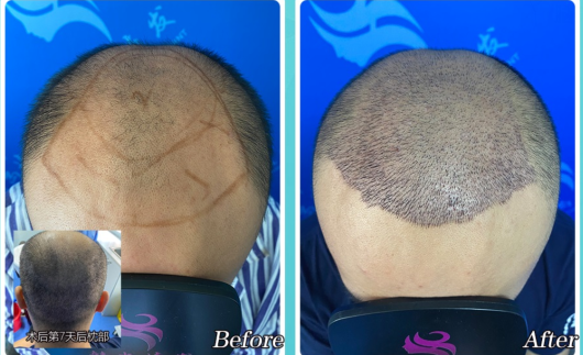 長春韓尚醫(yī)療種植頭發(fā)好不好?附禿頂植發(fā)經(jīng)歷分享+醫(yī)院價格表