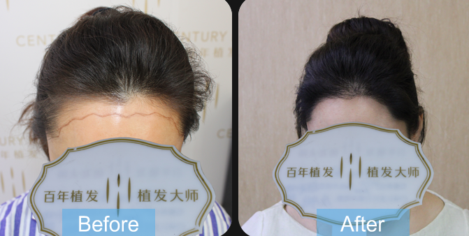蘇州哪里可以做植發(fā)?蘇州植發(fā)醫(yī)院排名前三!發(fā)際線種植效果如何?