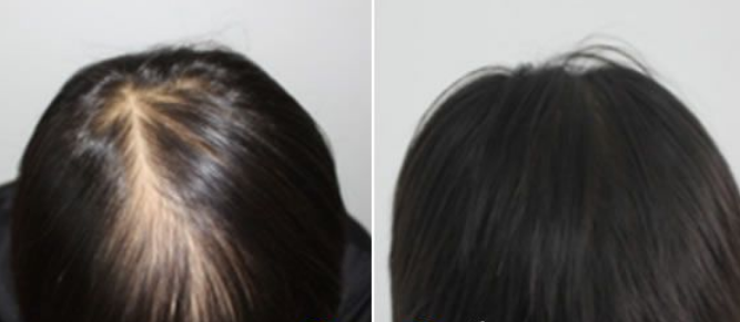 杭州新生植發(fā)醫(yī)院地址|醫(yī)院靠譜嗎?附頭發(fā)加密種植案例分享