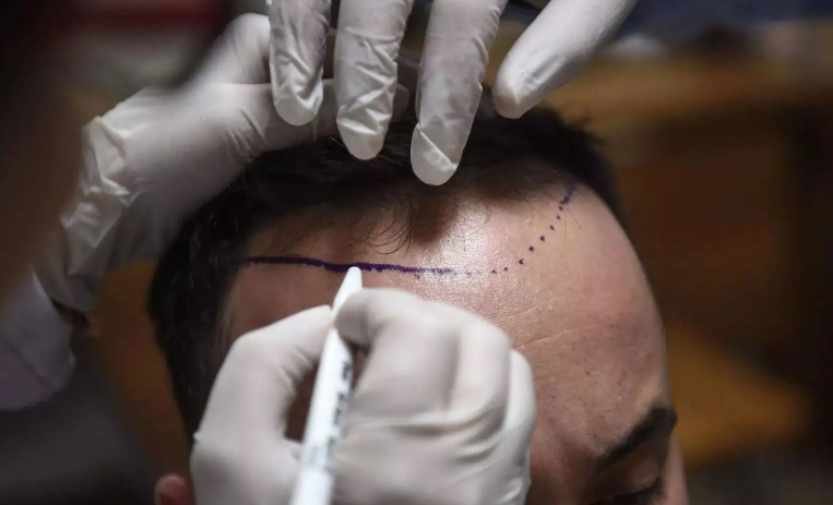 植發(fā)有用嗎