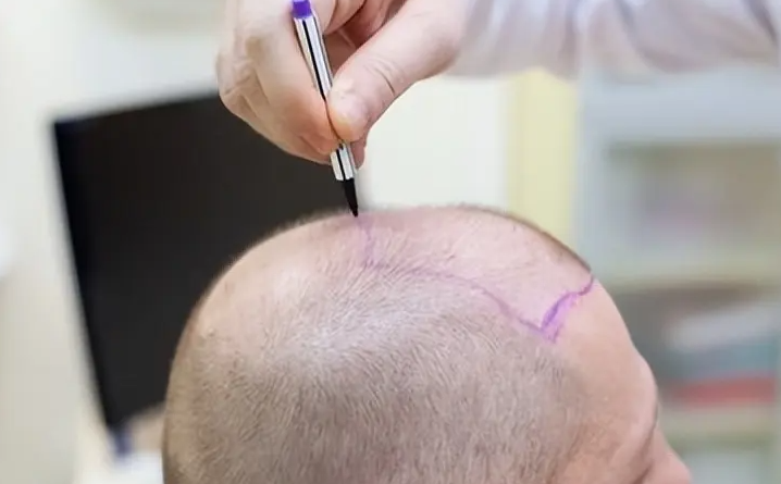 植發(fā)3000單位多少錢