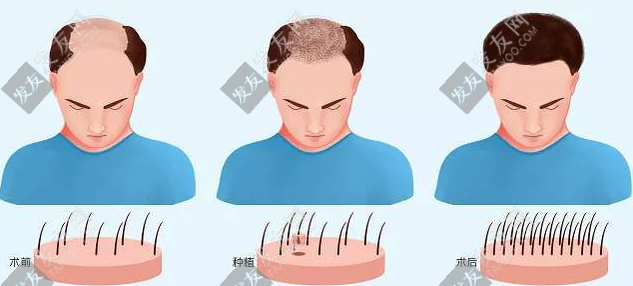 種頭發(fā)和植發(fā)