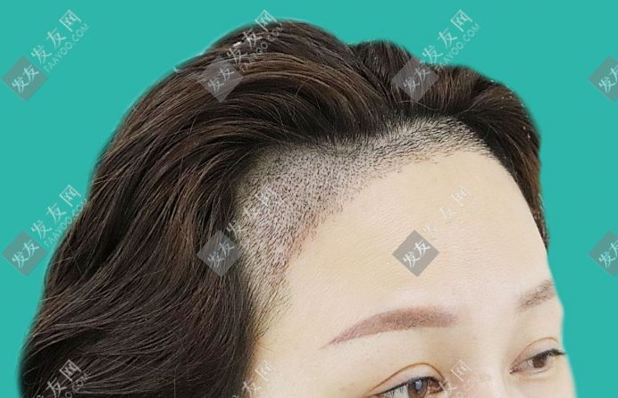 種頭發(fā)/植發(fā)一般多少錢