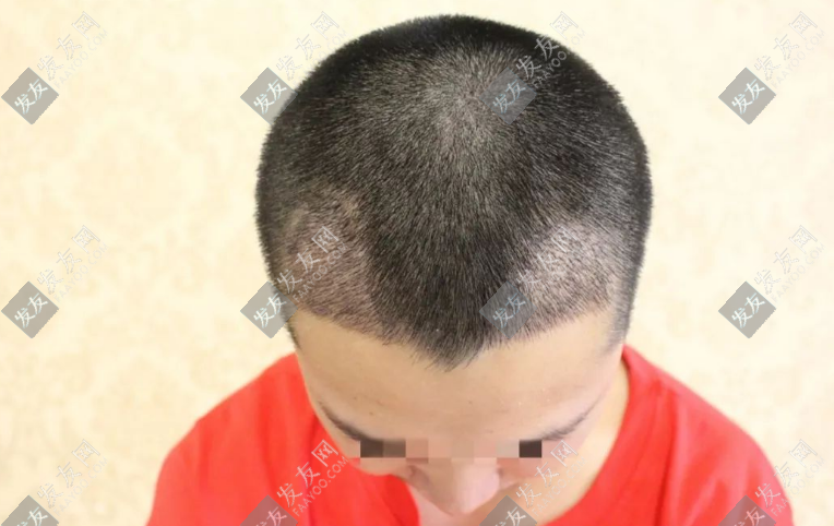 太原植發(fā)醫(yī)院排名前十