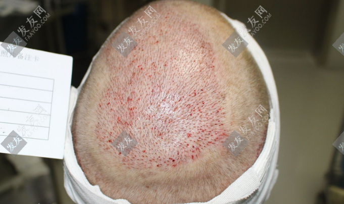 臨沂植發(fā)多少錢一般