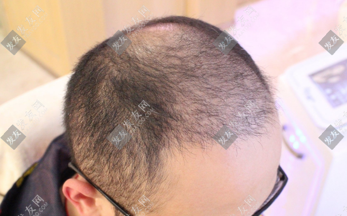 菏澤植發(fā)要多少錢一般