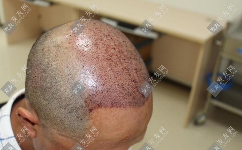 威海植發(fā)醫(yī)院排名哪家好？熱門(mén)植發(fā)醫(yī)院推薦！