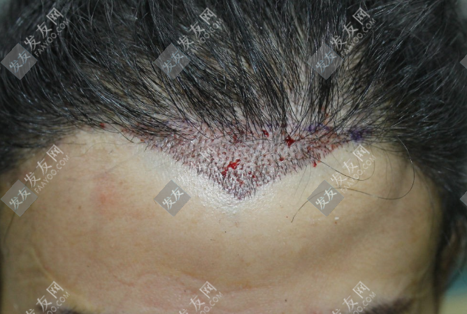 許昌植發(fā)要多少錢一般