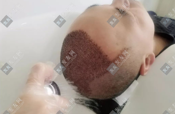 許昌植發(fā)醫(yī)院有哪些（可以植發(fā)的醫(yī)院）