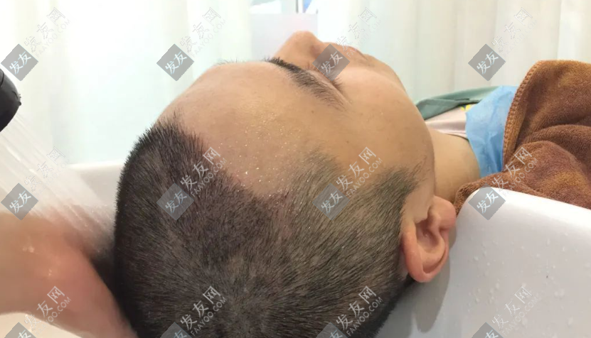 蕪湖植發(fā)醫(yī)院哪家比較好