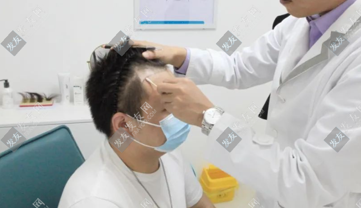 衡陽植發(fā)價格大概多少錢