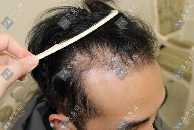 大麥植發(fā)3000個(gè)毛囊多少錢(qián)