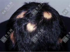 斑禿怎么原因形成的，好不好治